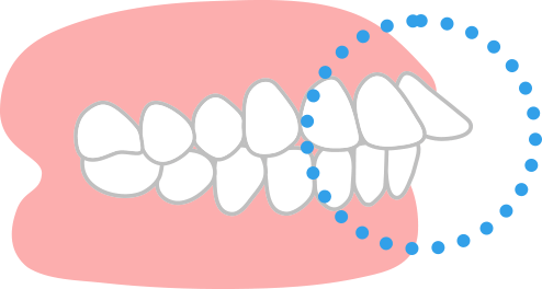 前歯が出ている