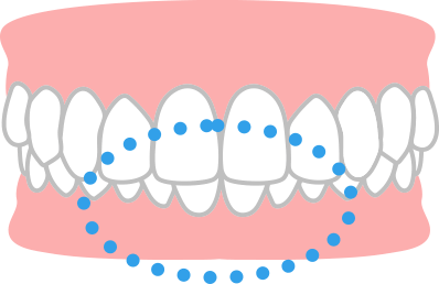 噛み合わせが深い
