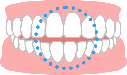 前歯が噛み合わない
